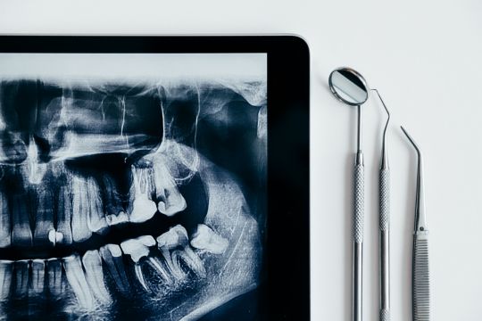 tooth extractions