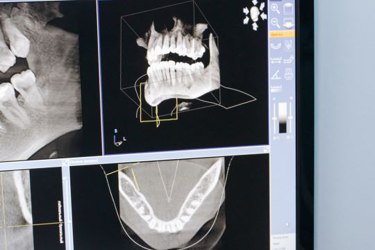 sinus lift Phoenix Dental